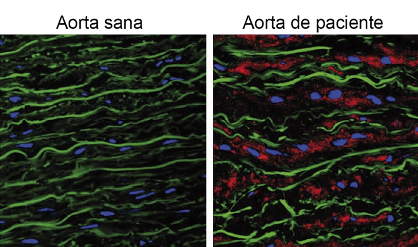 Accumulation of the protein versican is the cause of aortic aneurysm in Marfan syndrome