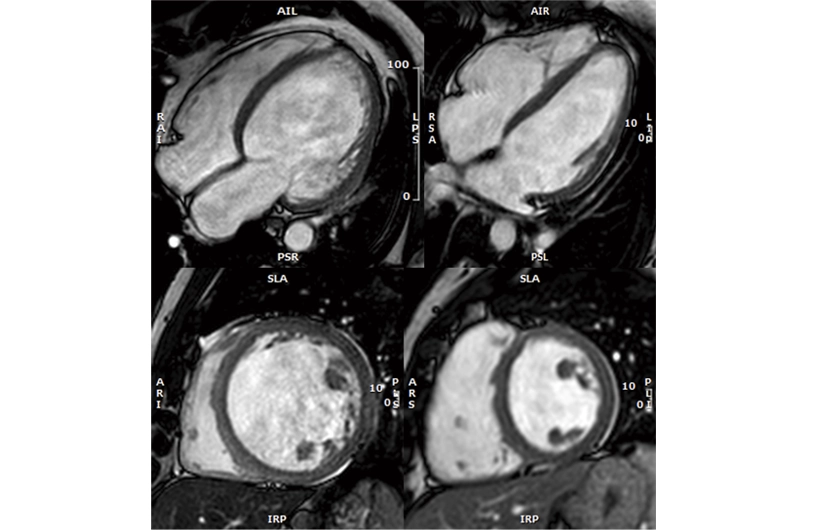 A new Spanish study provides the first stratification of the risk of developing dilated cardiomyopathy among symptom-free genetic carriers