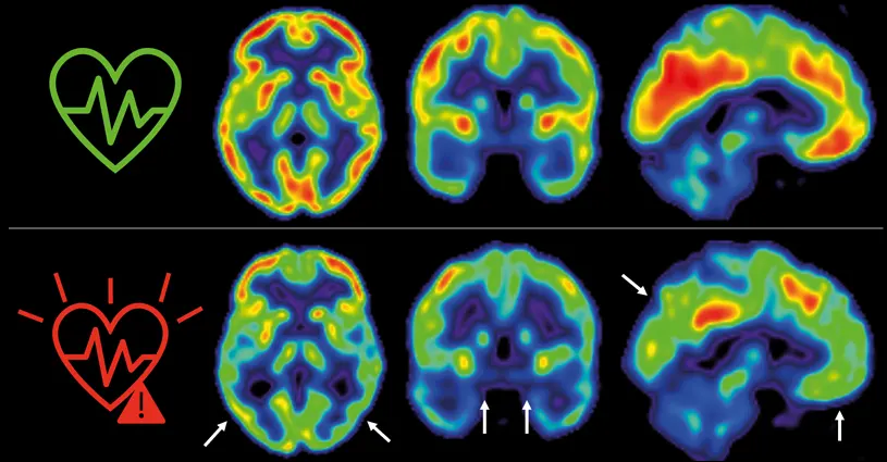 Cuanto antes empecemos a controlar los factores de riesgo cardiovascular, mejor para nuestro cerebro