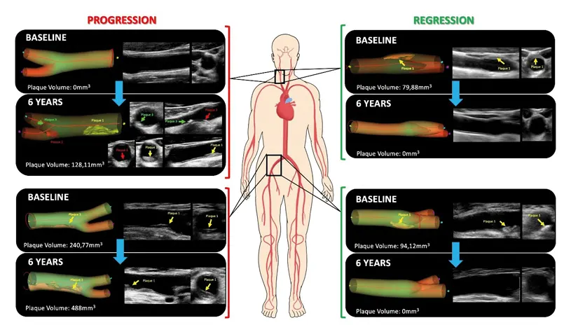 Las personas jóvenes son más vulnerables al dañino efecto del colesterol y la tensión arterial elevada