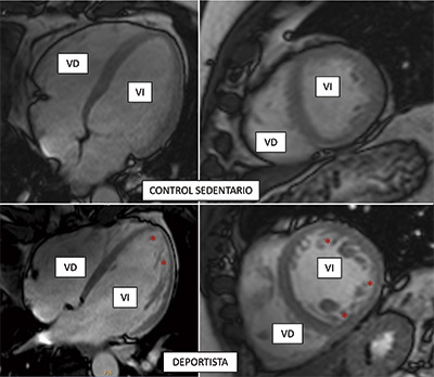 JACC. Ejercicio vigoroso, corazón esponjoso