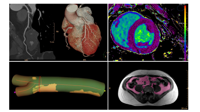 Nuestro enfoque se centra en el uso de modalidades de imagen para estudiar la salud cardiovascular y la transición al daño subclínico y la enfermedad cardiovascular establecida a lo largo de la vida.