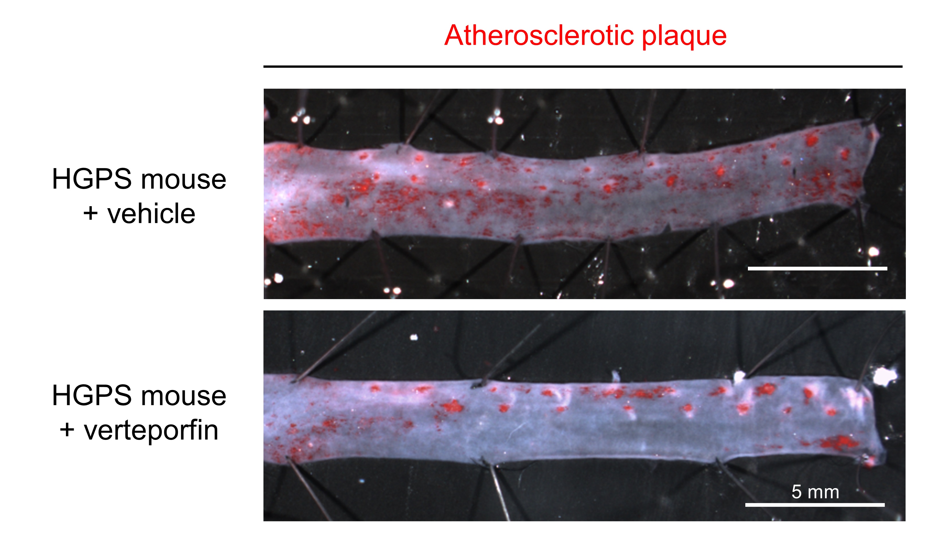 Oil Red O staining in aortas from HGPS mice treated with vehicle or verteporfin. Lipids accumulating in atherosclerotic plaques are stained red. 