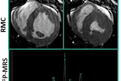 Imagen RMC: El tratamiento con empagliflozina preserva la función cardíaca y la energética del miocardio. Imagen de MRS: El tratamiento con empagliflozina preserva la energética del miocardio.